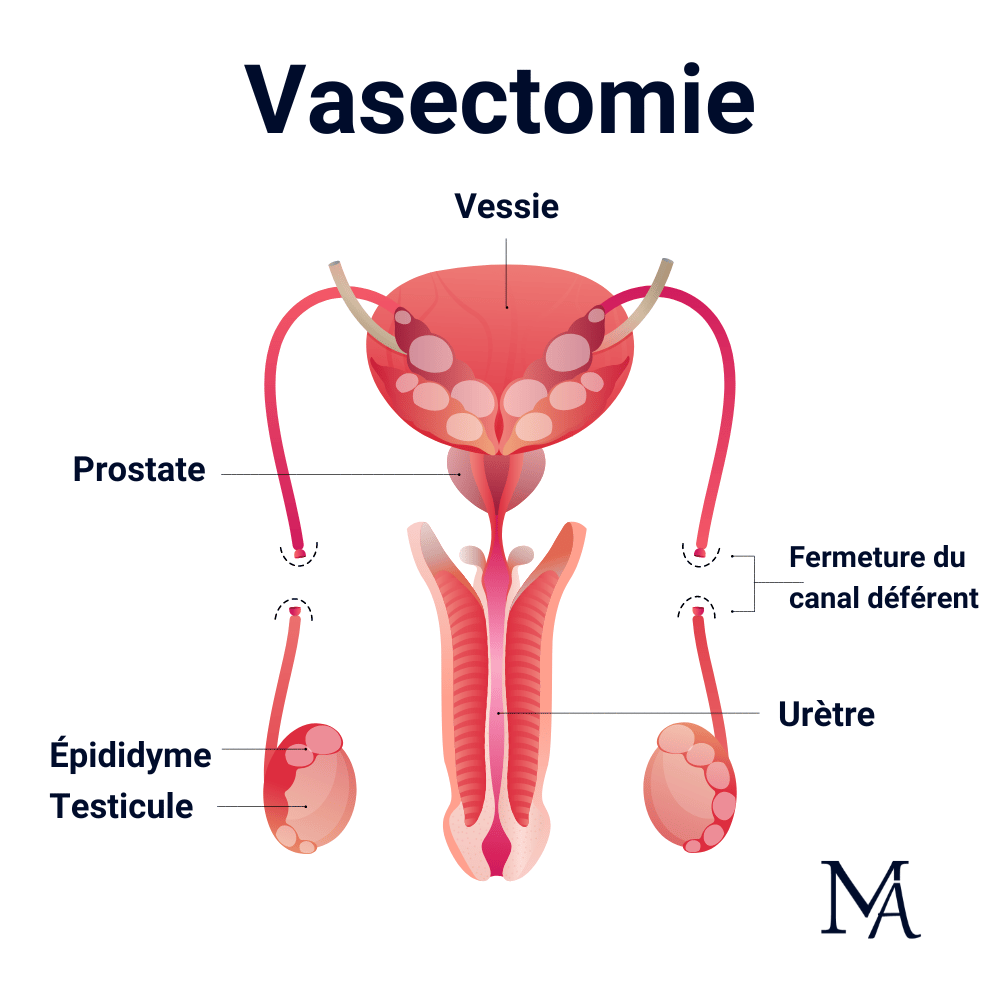 problemi di erezione dopo la vasectomia