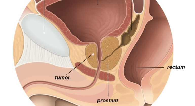 spiegazione del cancro alla prostata